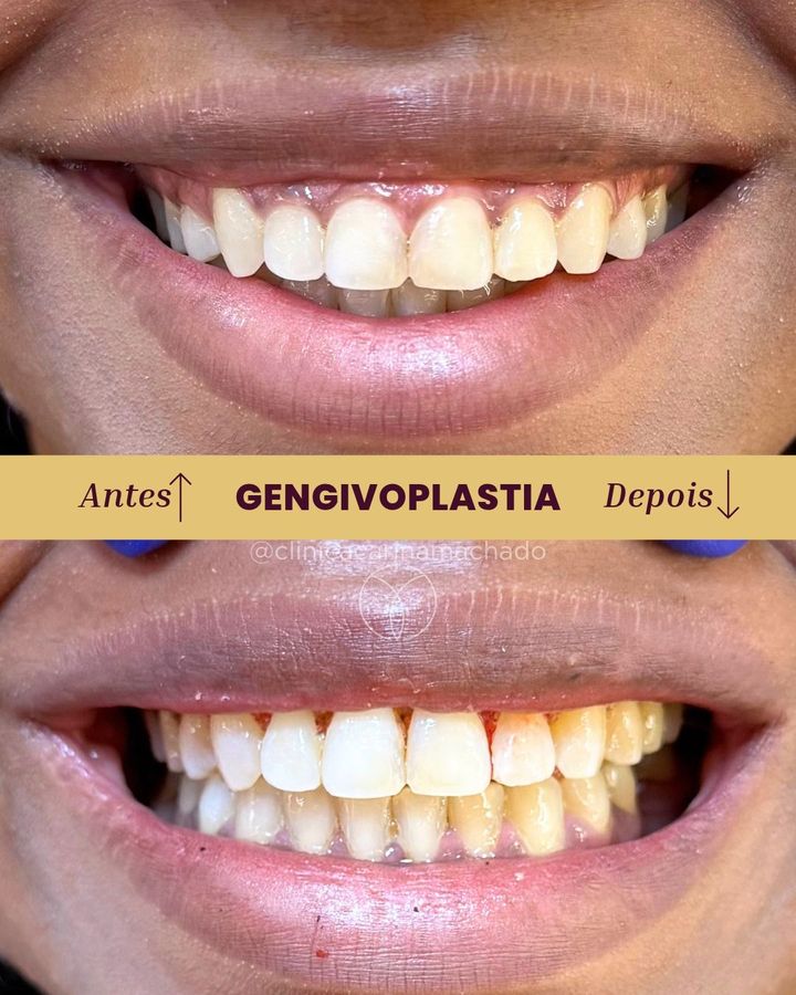 Antes e depois: Gengivoplastia