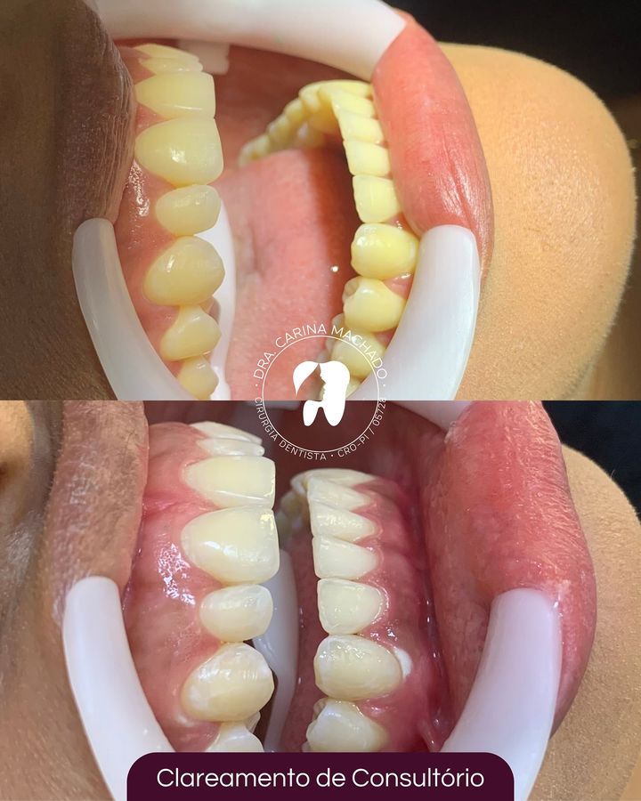 Antes e depois: Clareamento de consultório