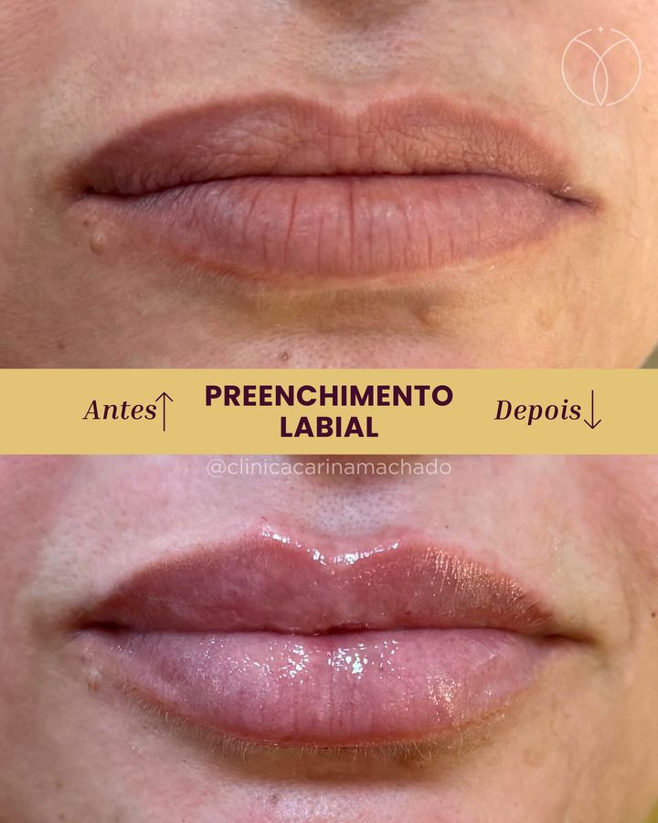 Antes e depois: Preenchimento labial