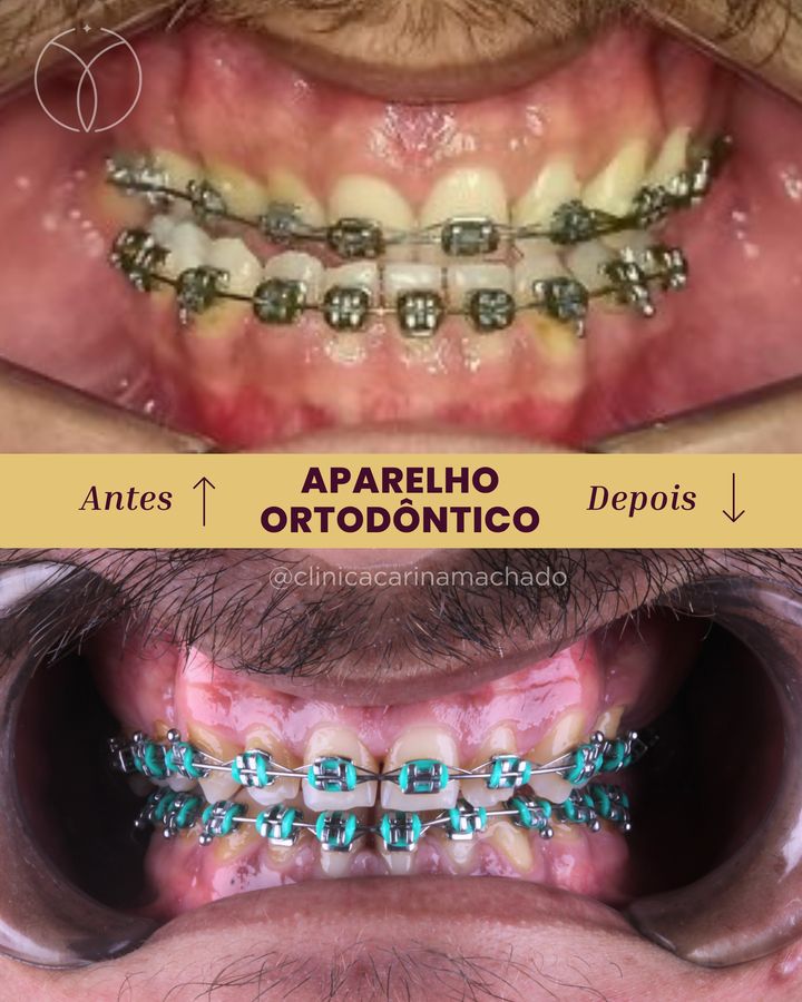 Antes e depois: Aparelho ortodôntico