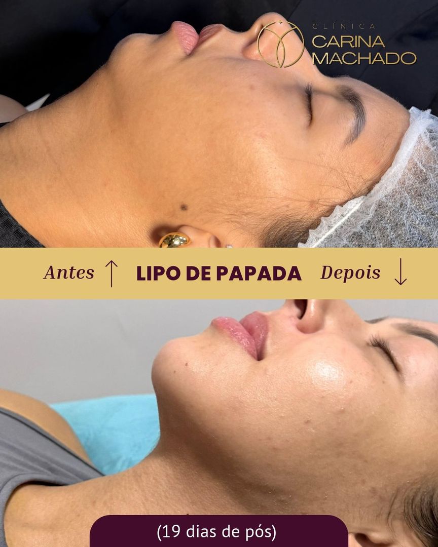 Antes e depois de lipo de papada, 19 dias de pós