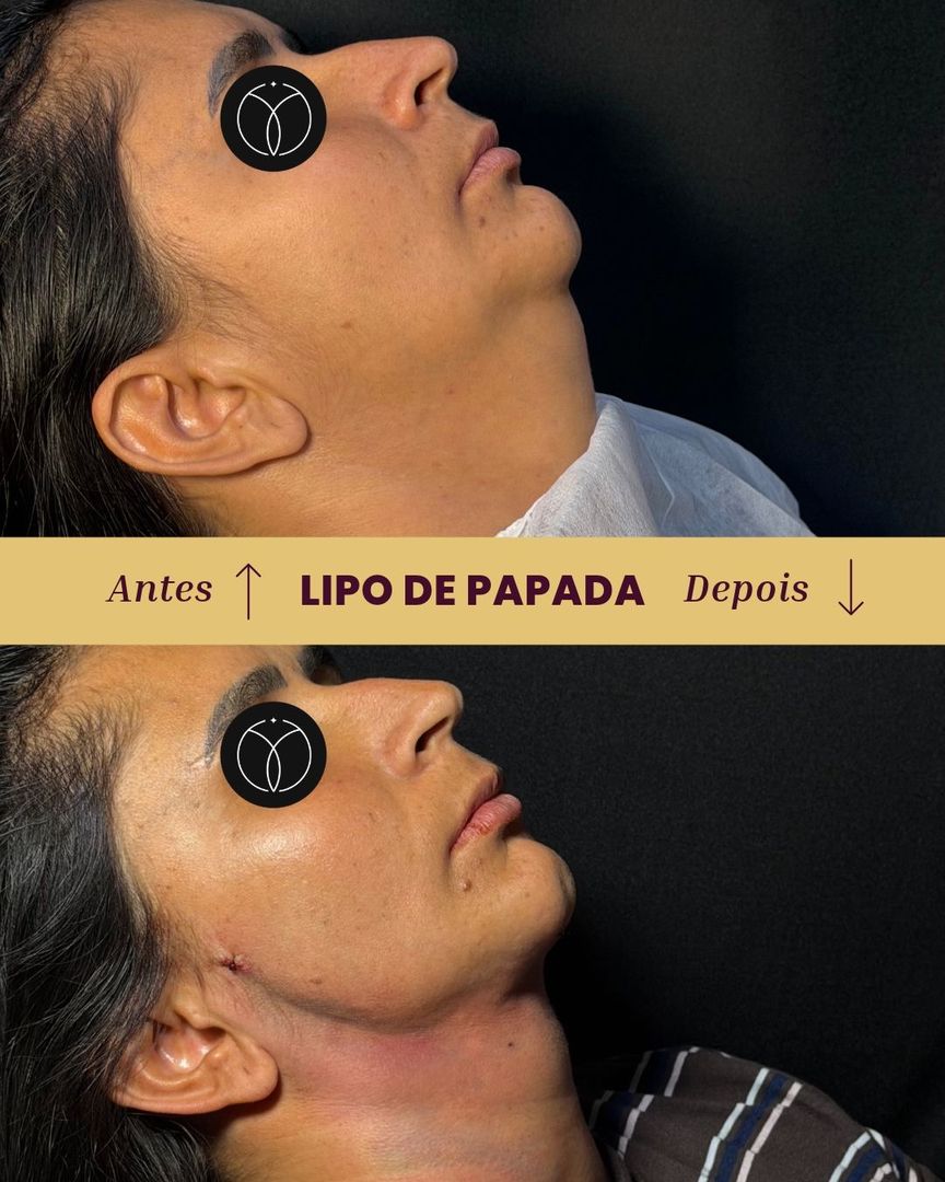Antes e depois de lipo de papada